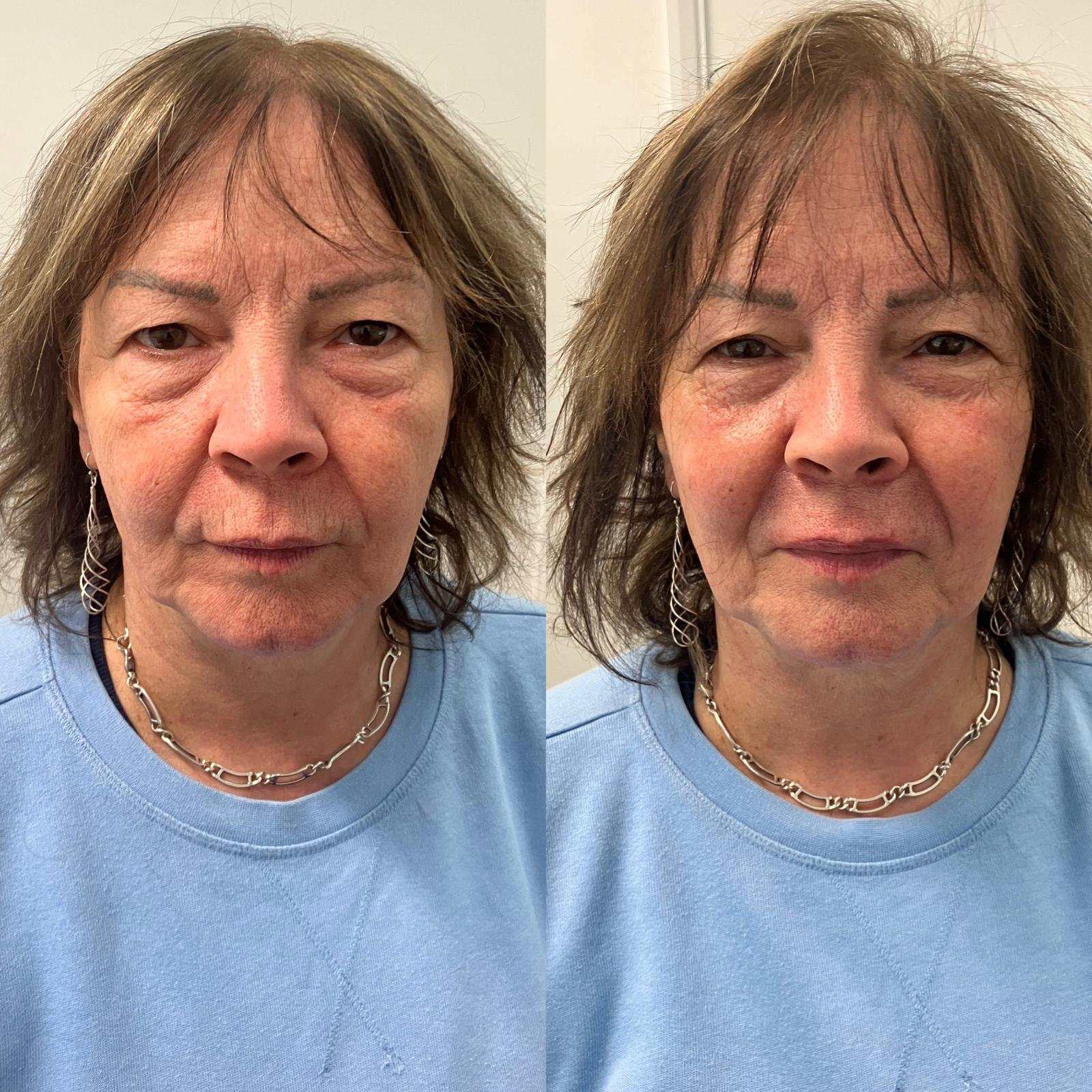 Before and after skincare treatment result showing natural-looking facial refresh