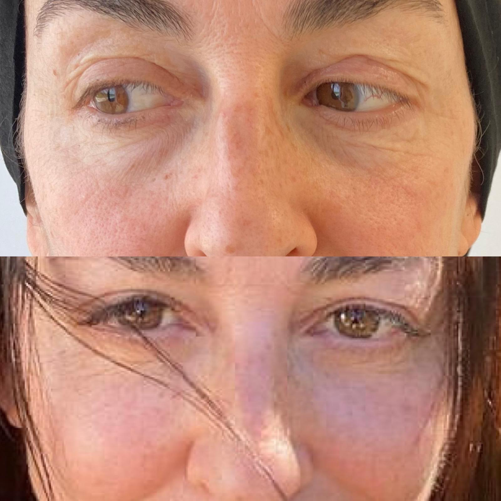 Before and after under-eye treatment result showing a natural-looking refresh